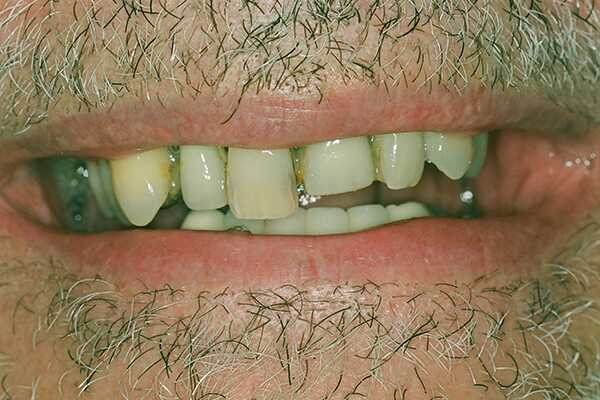 Before Dental Implants - Finsbury Dental Care
