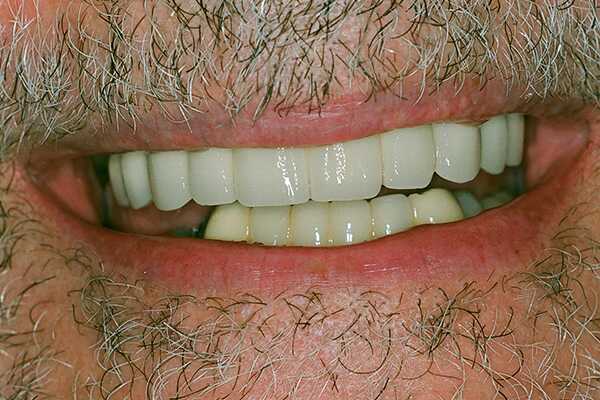 After Dental Implants - Finsbury Dental Care